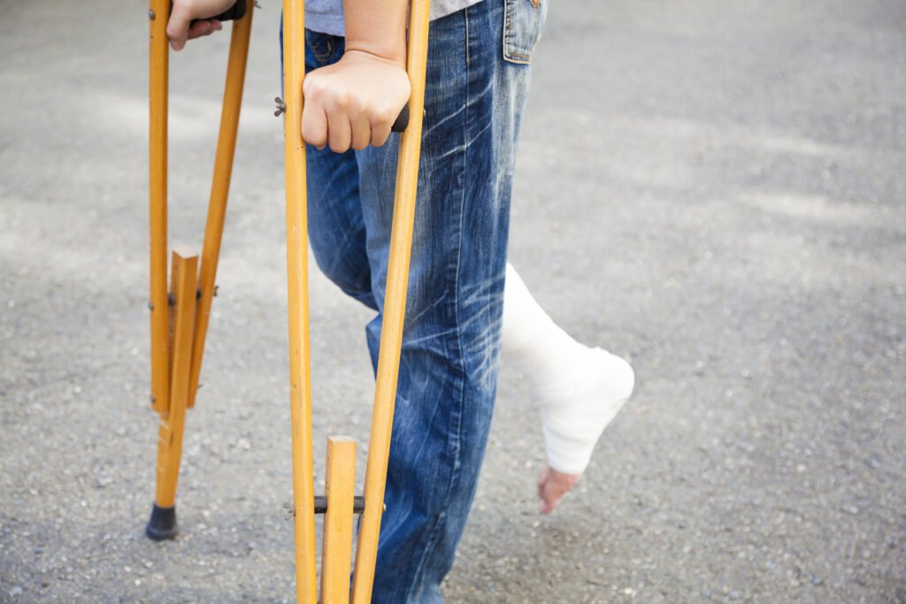 Douleurs 2 ans après un zona closeup of leg on bandage with crutches